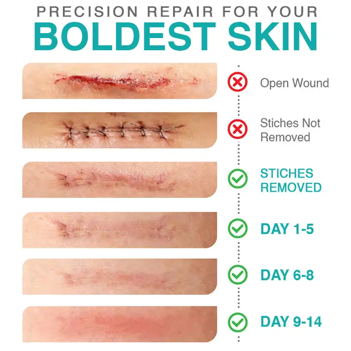 ๐๐ฎ๐ฟ๐ฒ๐๐ฟ๐ฒ๐ฒ๐๐ฒยฎ 3-in-1 micronaaldverzorgingspatch - Image 4