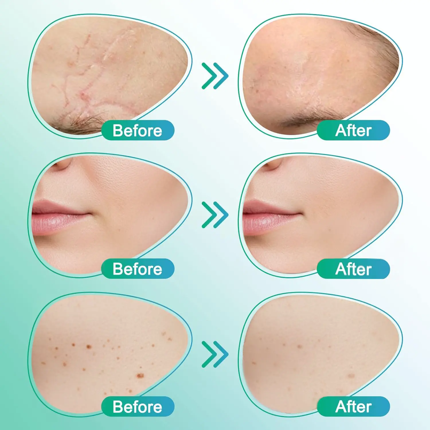 ๐๐ฎ๐ฟ๐ฒ๐๐ฟ๐ฒ๐ฒ๐๐ฒยฎ 3-in-1 micronaaldverzorgingspatch - Image 5