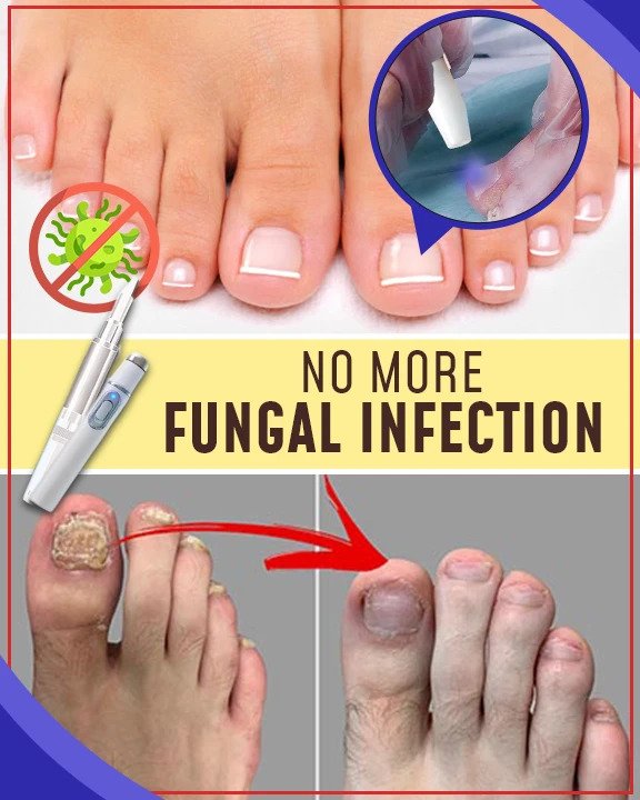 Anti-schimmelbehandelingssets voor blauw licht - Image 3