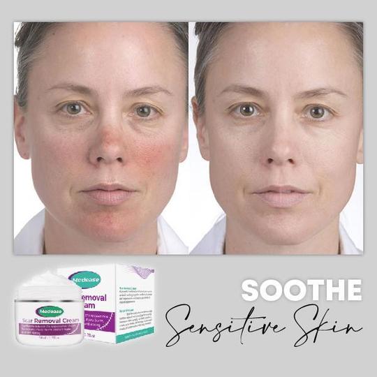 Medease Huidrebound Crème - Image 6