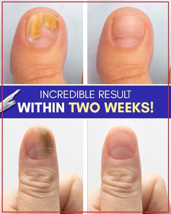 Anti-schimmelbehandelingssets voor blauw licht - Image 5