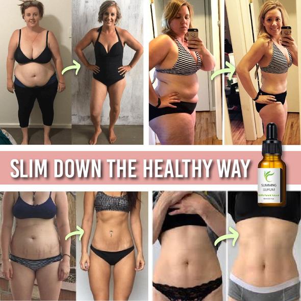 Buikwandcorrectie met vetverbrandingsserum - Image 6