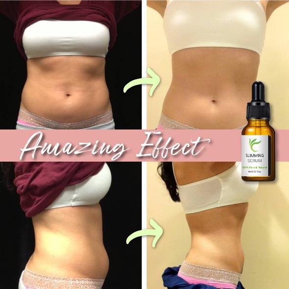 Buikwandcorrectie met vetverbrandingsserum - Image 7