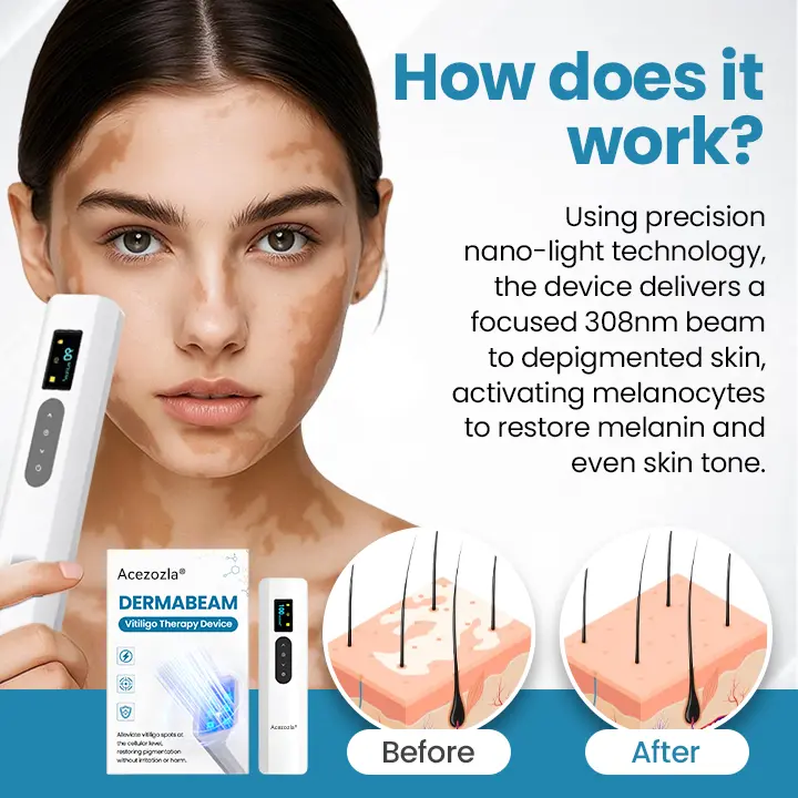Acezozla® DermaBeam Vitiligo-therapieapparaat - Image 3