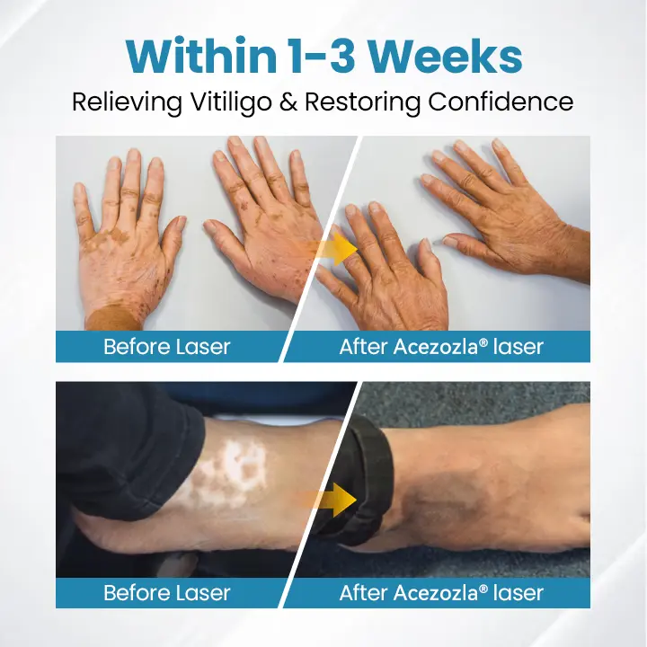 Acezozla® DermaBeam Vitiligo-therapieapparaat - Image 4