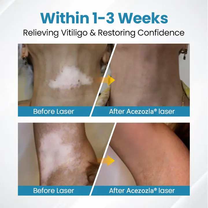 Acezozla® DermaBeam Vitiligo-therapieapparaat - Image 5
