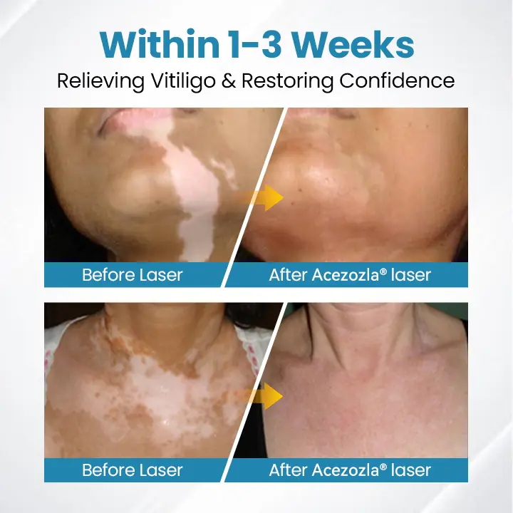 Acezozla® DermaBeam Vitiligo-therapieapparaat - Image 7